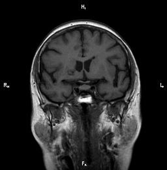 МРТ снимок кавернозной ангиомы