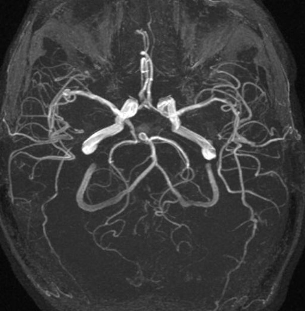 МРТ снимок аневризмы основной артерии